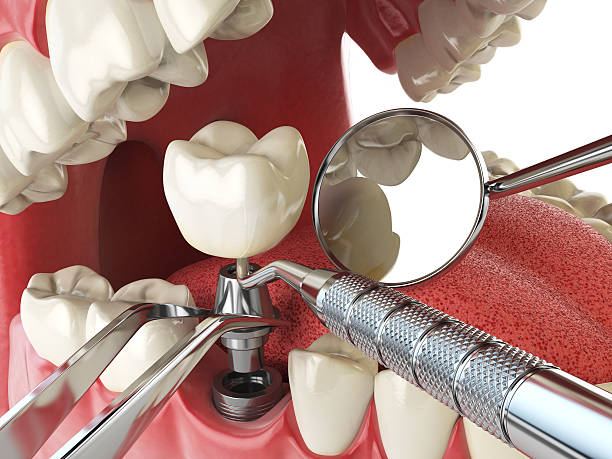 Best Emergency Wisdom Tooth Extraction in St Bonifacius, MN